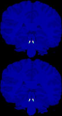 Automatic geometry-based estimation of the locus coeruleus region on T1-weighted magnetic resonance images